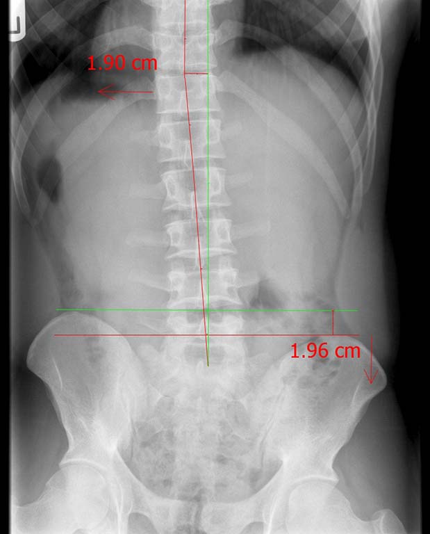 precision chiropractic Spine Lumbar xray before